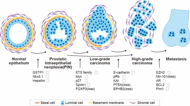 前列腺癌進展模型